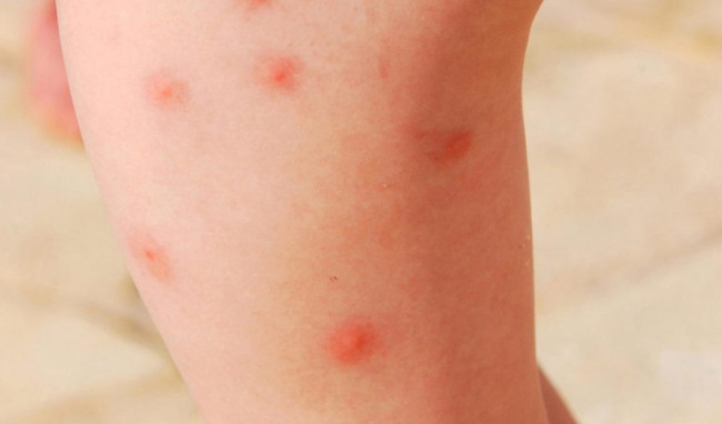 7 Biện Pháp Khắc Phục Muỗi Đốt Ở Trẻ Em