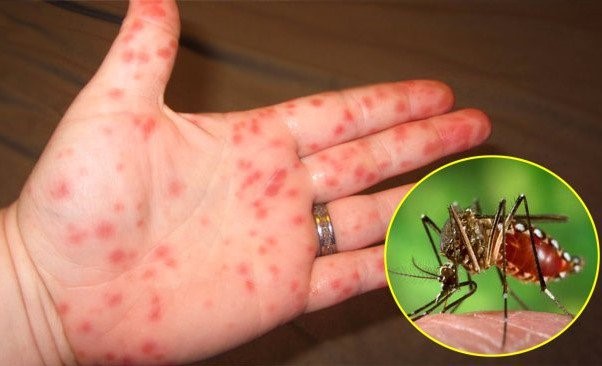 Top những căn bệnh nguy hiểm từ muỗi gây ra