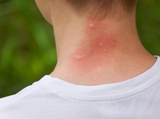 Các triệu chứng khi bị muỗi đốt và phòng chống muỗi hiệu quả bằng cửa lưới