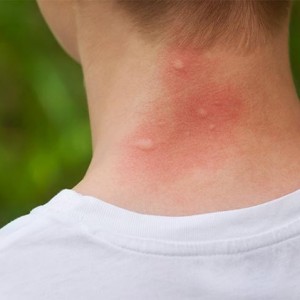 Các triệu chứng khi bị muỗi đốt và phòng chống muỗi hiệu quả bằng cửa lưới